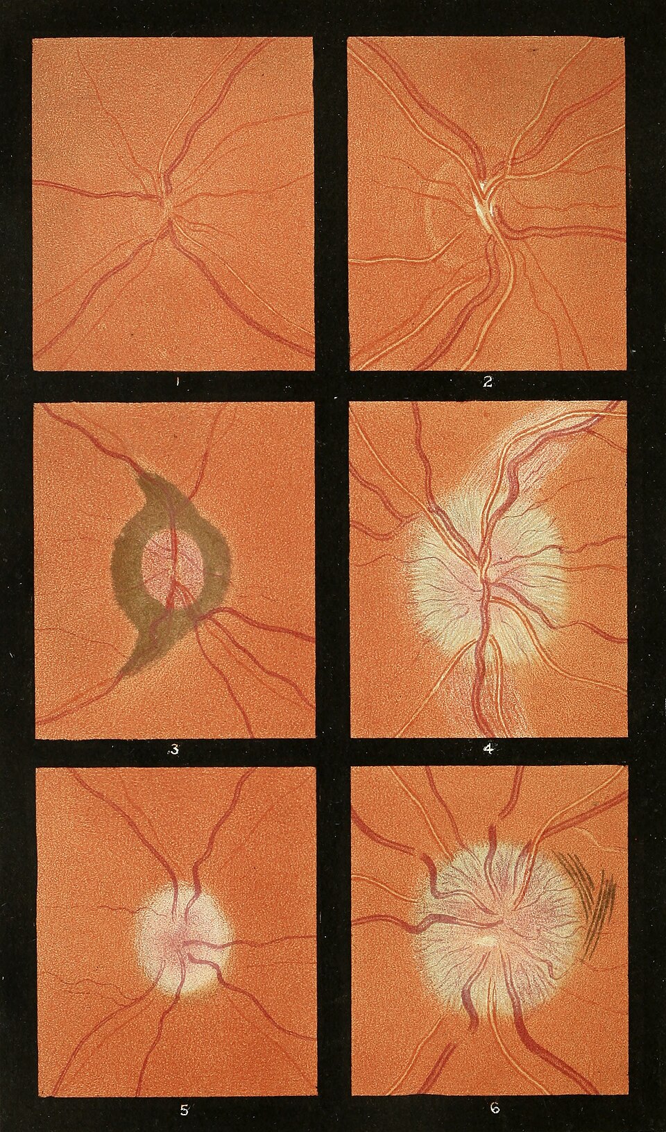 Tavola storica di oftalmoscopia: sei illustrazioni del fondo oculare tratte da un atlante medico del XIX secolo